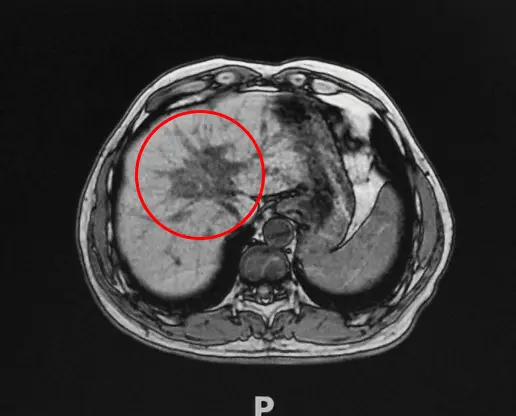 Advantages and Research of Cryoablation Pancreatic Cancer