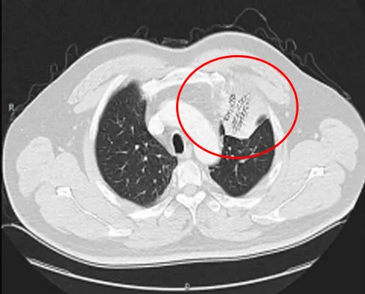 Comparison Results of Cryotherapy and Traditional Lung Metastasis Therapy