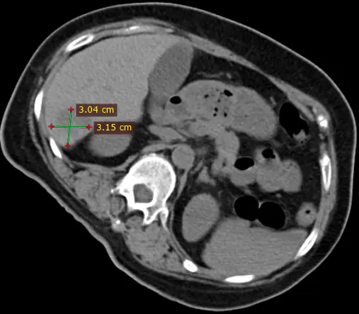 Minimally Invasive Techniques for Liver Cancer: The Role of Cryotherapy