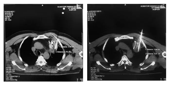 Ablation-two cycles