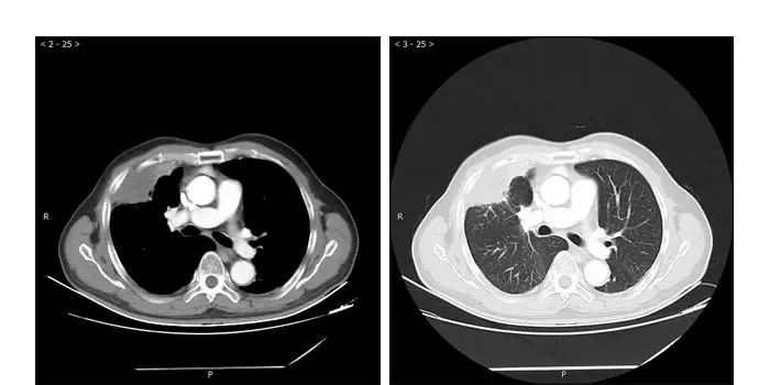 Reexamination 1 month after surgery