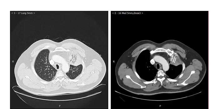 Reexamination 1 month after surgery