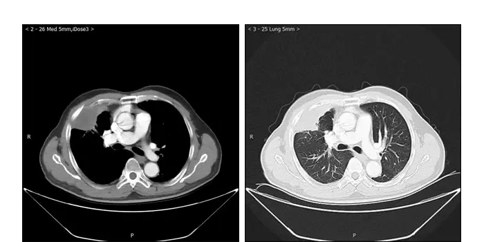 Reexamination 6 months after surgery showed complete remission (CR)