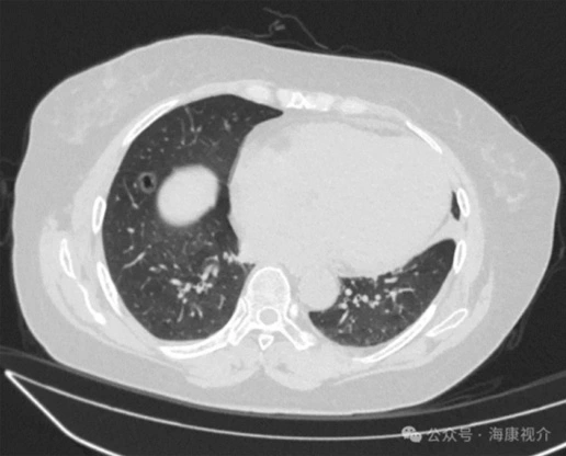 Cryosurgical System for Lung Cancer