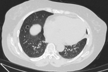 Case Sharing | Cryosurgical System for Lung Cancer