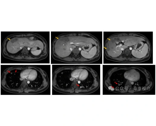 Cryosurgical System for Lung metastasis of liver cancer