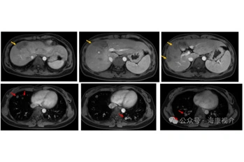 Case Sharing | Cryosurgical System for Lung metastasis of liver cancer