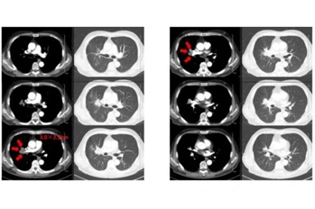 Case Sharing | Cryosurgical System for Lung Metastatic Malignant Tumors